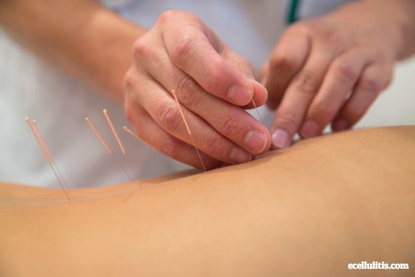 Acupuncture for Cellulitis