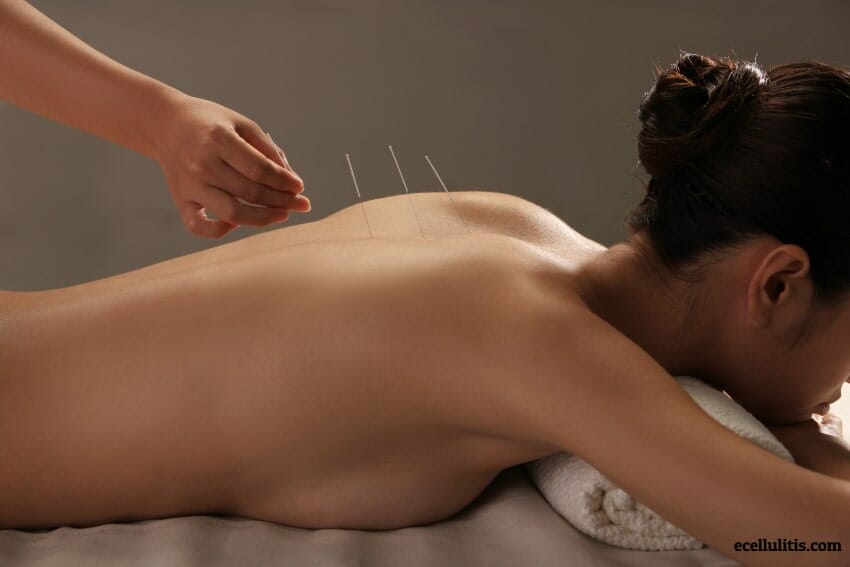 acupuncture as a a natural defense against colds and flu