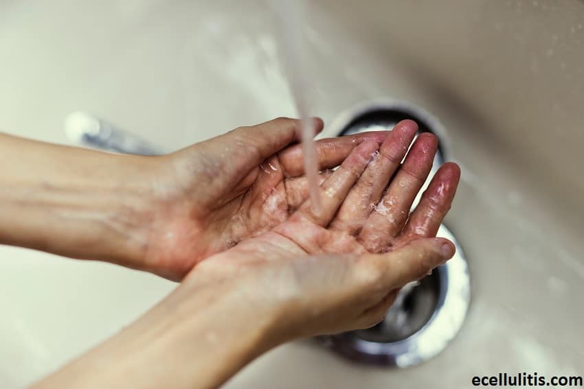 Keeping an Eye on the Hygiene to Prevent Cellulitis