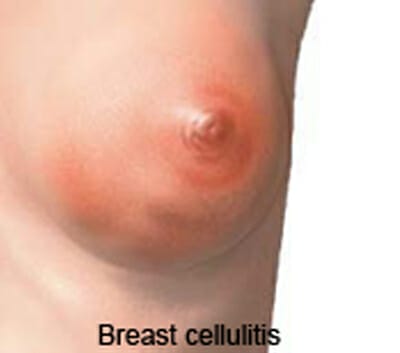 breast cellulitis picture