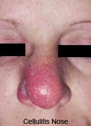 nasal cellulitis picture