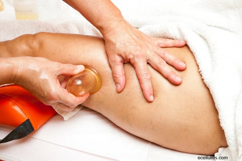 How To Get Rid of Stage Three Cellulite By Using Massage (Cupping for Cellulite)