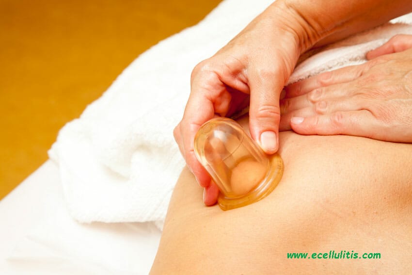 cupping for cellulite - anti-cellulite massage