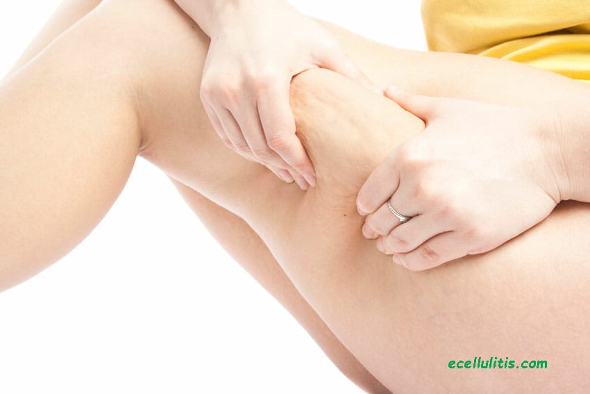 young woman showing cellulite