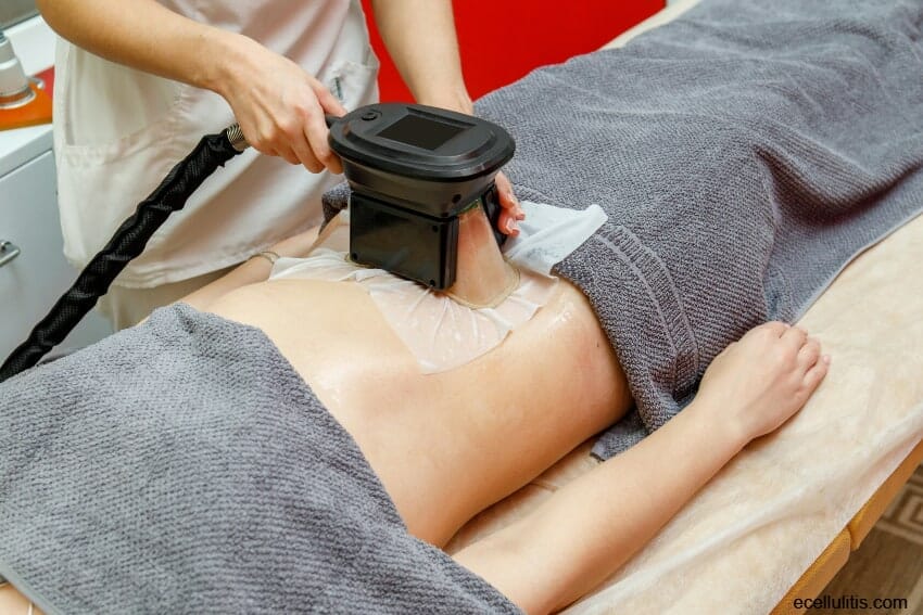 coolsculpting as alternative to a surgical procedure