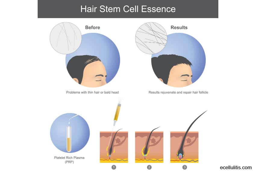 prp hair treatment for hair loss 