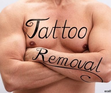laser tattoo removal treatment details