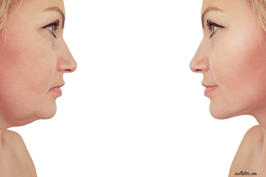 submental fat also known as a double chin